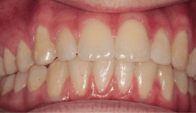 After - DNTL Smiles