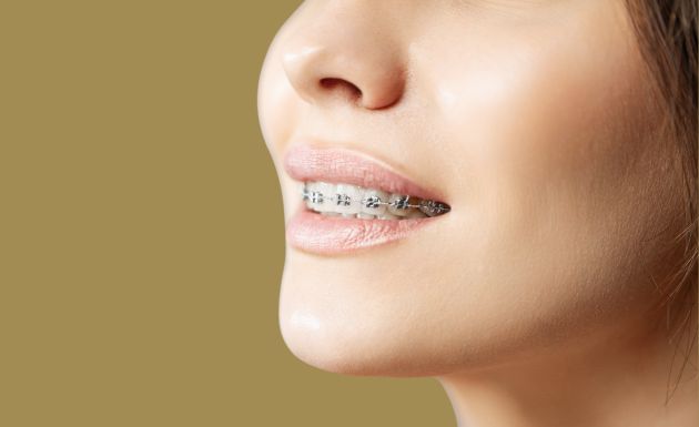 Fixed Braces