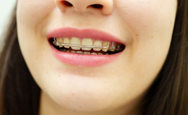 Inman Aligners