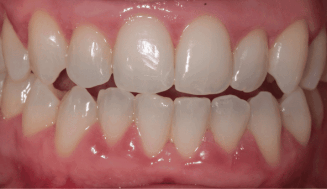 After - DNTL Smiles