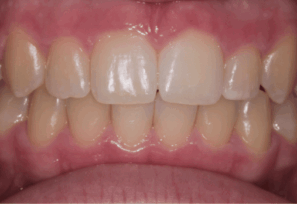 After - DNTL Smiles