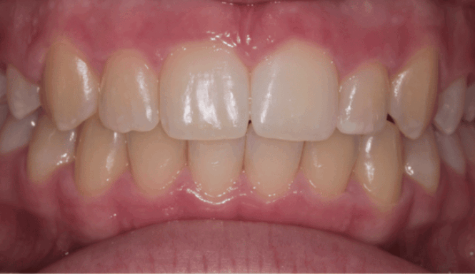 After - DNTL Smiles