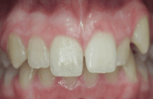 Before - DNTL Smiles