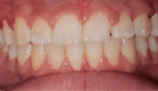 After - DNTL Smiles