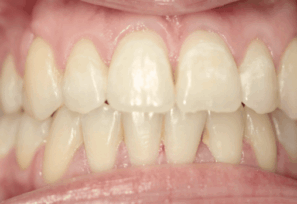 After - DNTL Smiles