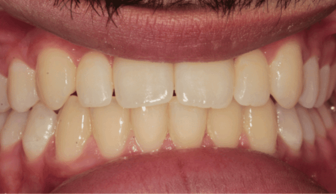 After - DNTL Smiles