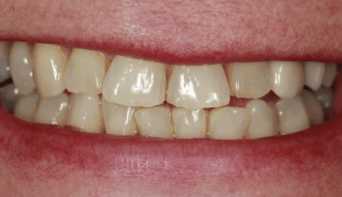 After - DNTL Smiles