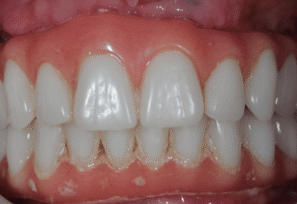 After - DNTL Smiles