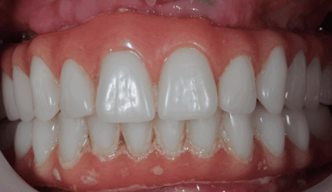 After - DNTL Smiles