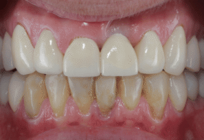 After - DNTL Smiles