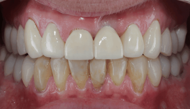 After - DNTL Smiles