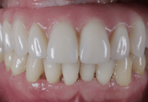 After - DNTL Smiles