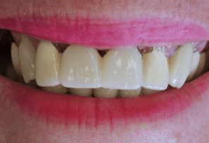 After - DNTL Smiles