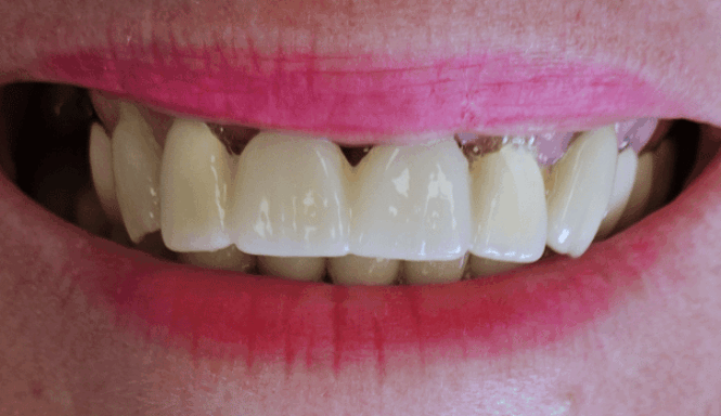 After - DNTL Smiles