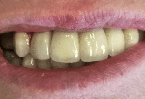 After - DNTL Smiles