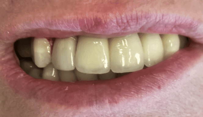 After - DNTL Smiles & Wellness