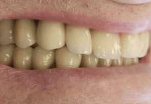 After - DNTL Smiles